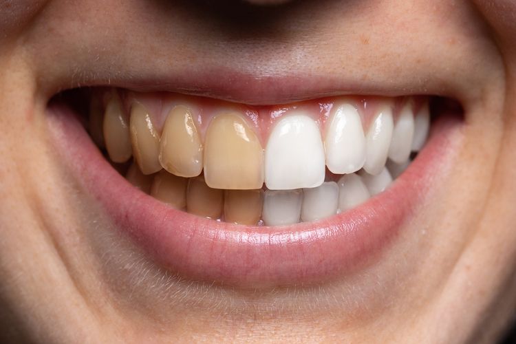 Senyum Memikat: Tips dan Trik Kecantikan Gigi agar Terlihat Putih Alami
