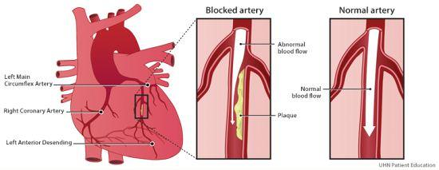 Penyakit Jantung: Menghubungkan Nyeri di Bawah Payudara dengan Kondisi Kardiovaskular