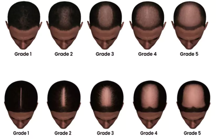A graphic presenting different types of baldness, including male pattern baldness, alopecia areata, and telogen effluvium, with arrows pointing to affected areas on the scalp.